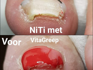 Nagelbeugel bij ingroeiende nagel