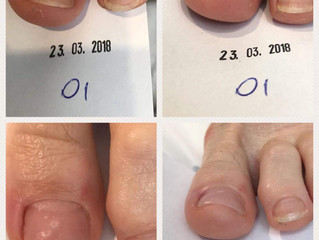 Behandeling Ingroeiende nagel d.m.v. een Gelbeugel of "Arkada" techniek