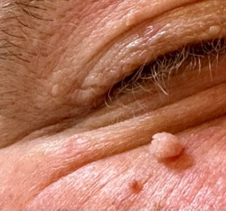 Wrt Filiform Pattern Before&After | Cj Skin Clinic
