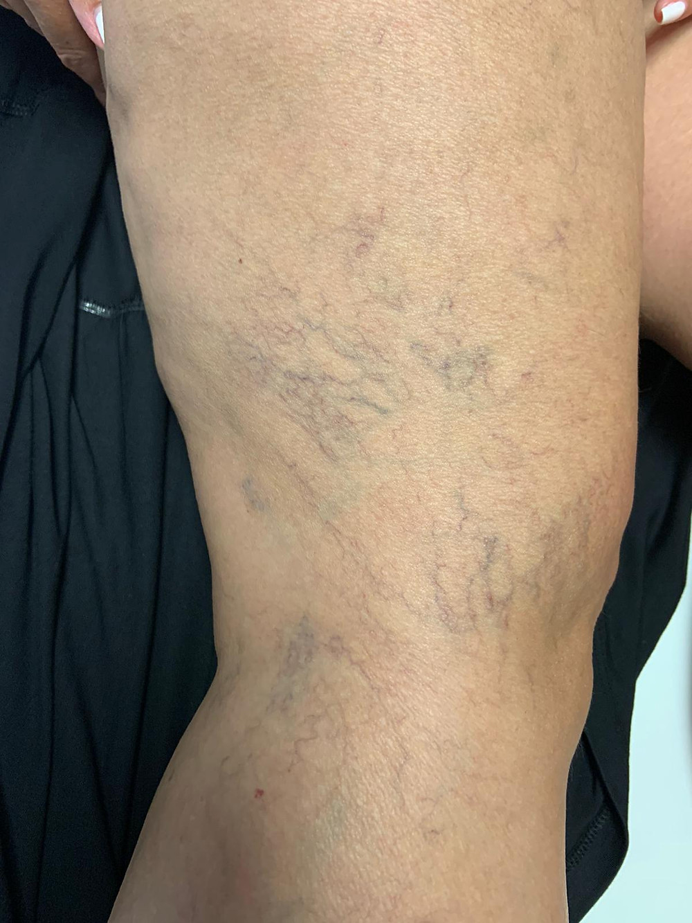 Imagen de pierna con venas vasculares