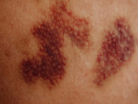 A sexta praga: úlceras | Êxodo 9:8-12