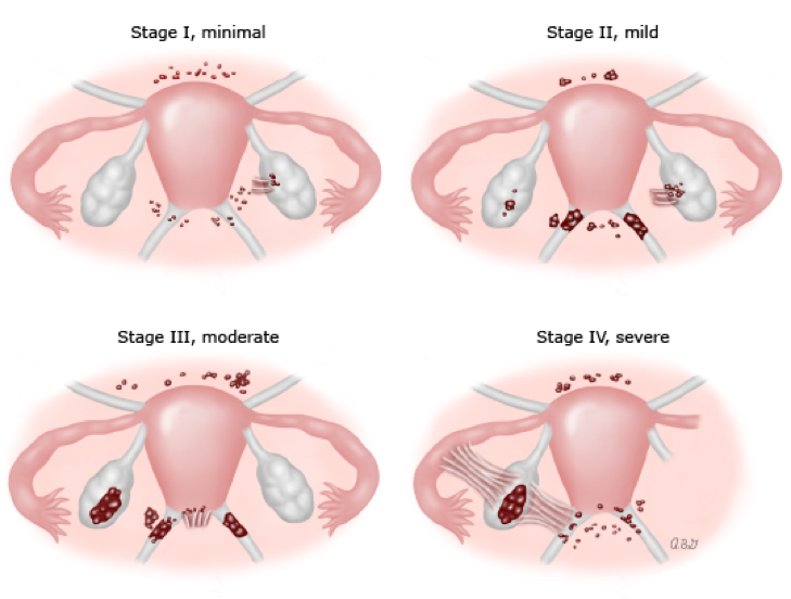 Beyond the Pain: Endometriosis & Osteopathy