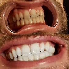 Before and after LED teeth whitening