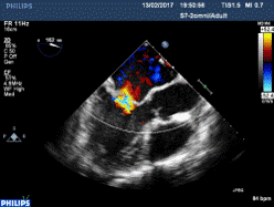 Insuficiencia mitral1.gif