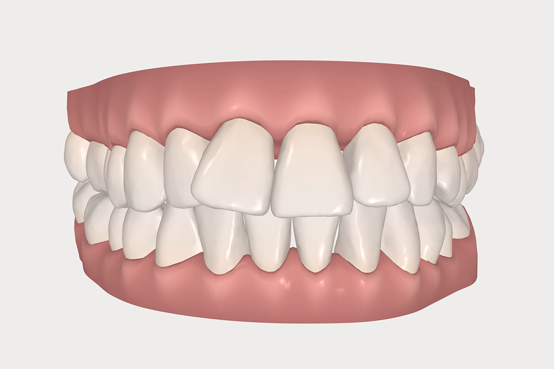 invisalign animation clincheck illustrating how teeth move with Invisalign