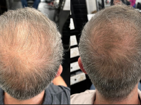 ProCell Therapies for Hair and Scalp Regrowth in Glendale, California