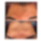 botox.jpg