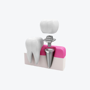 dental implant image