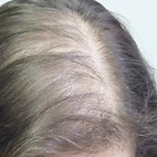 Example of scalp issue Spot thinning hair areas and track growth progress