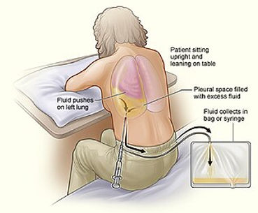 Thoracentesis.jpg