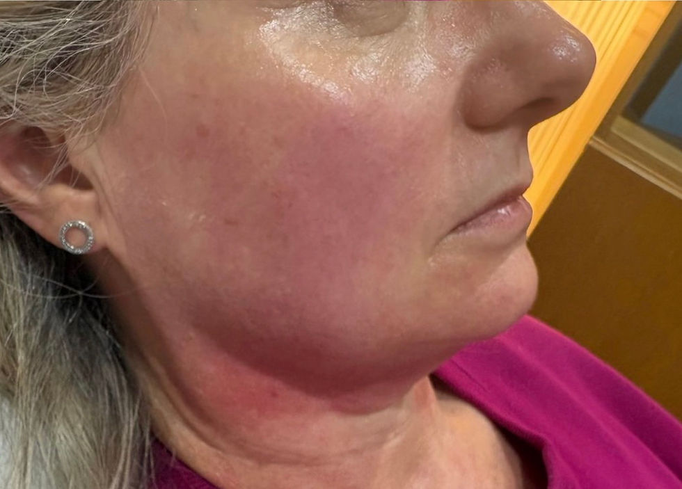 after natural facelift