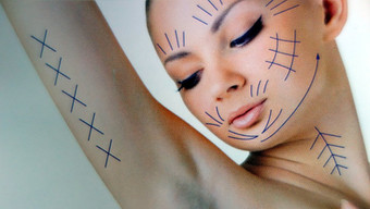 Fadenlifting - Soft Lifting für Gesicht, Kinn, Arme
