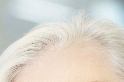 Haarausfall Behandlung - Frau