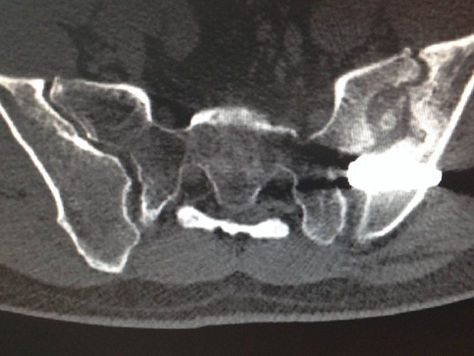 Prolaps, Protrusion, ISG?