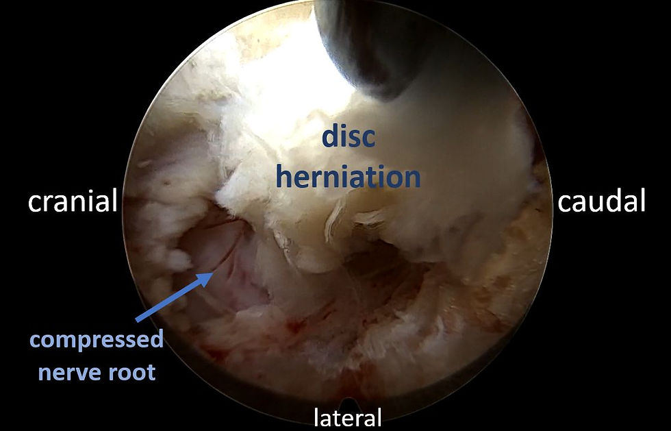 Disc Herniation - ©️ Dr. Vincent Hagel