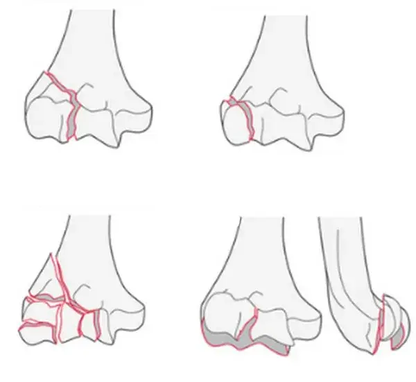 B-Lateral.webp