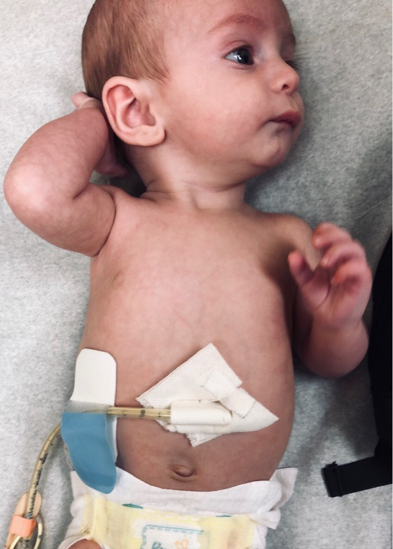 Life Hacks Feeding Tube Edition