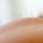 Dry needling treatment at All About Health Aldinga