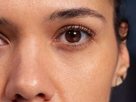 What Causes Dark Circles and How Does Treatment Help?