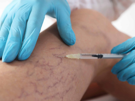 How Does Sclerotherapy Improve Vascular Health?