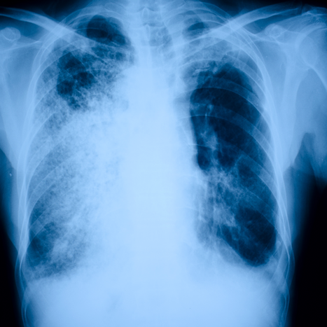 Diagnóstico microbiológico: ¿ es adecuado ordenar el antígeno urinario de Streptococcus pneumoniae en pacientes con neumonía adquirida en la comunidad?