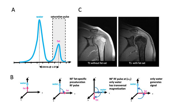 Chemical shift selective sequences (CHESS) for fat saturation (Fat-Sat)