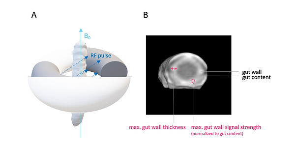 M. sexta in MR imaging and imaging findings for phenotyping of colitis-like lesions