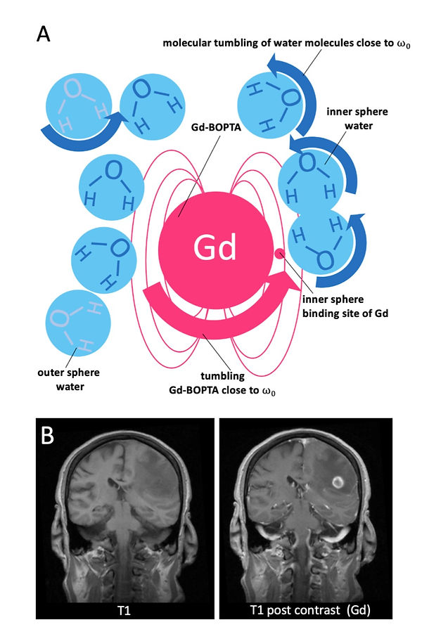 Paramagnetic relaxation enhancement of inner and outer sphere water due to gadolinium and non-small cell lung carcinoma (NSCLC) metastasis with contrast uptake.