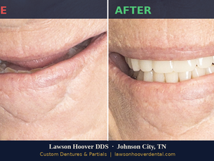 Same-Day Dentures Near Johnson City, TN: What You Should Know