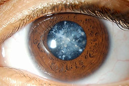 X-Ray induced Catarac.jpeg