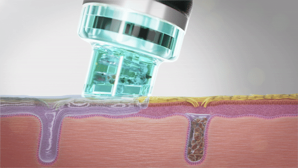 HYDRAFACIAL