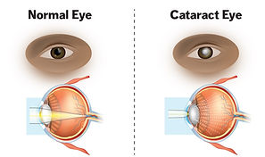 Cataract_edited.jpg