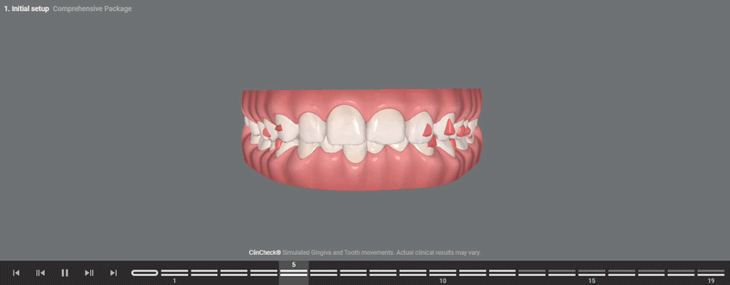 Invisalign Digital treatment plan Fairfax VA