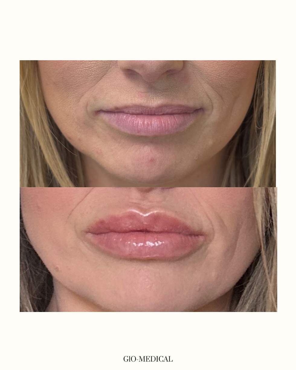 Before and After Glo Medical Aesthetics and Wellness Flowood