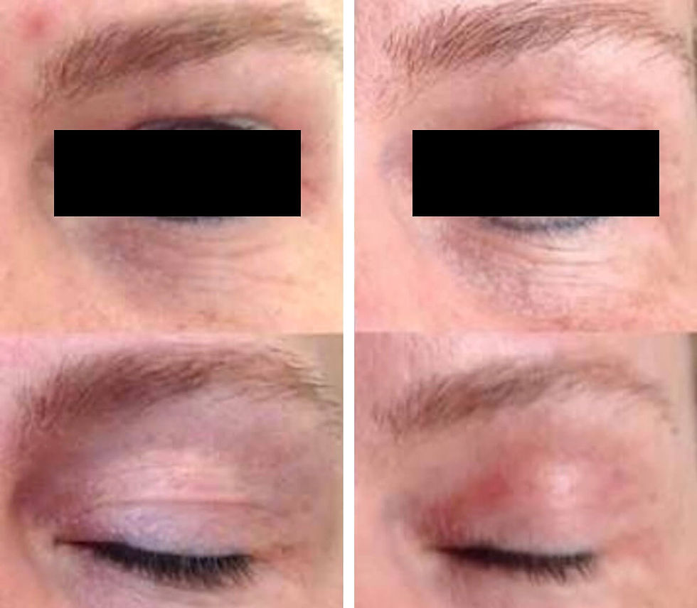 Blepharoplasty in Turkey