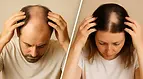 Hair Loss Support – Alopecia, Thinning Hair & Hormonal Scalp Health