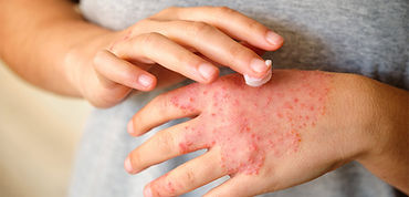 Homeopathic eczema treatment in Monroe Township NJ for children and adults seeking natural relief