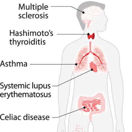 5 most common autoimmune disorders that can be managd with proper Homeopathic treament. Yourhomeopathy Specializing in maagement of chronic autoimmune diseases 07095