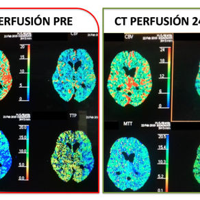 Our latest cases with Neuro Elutax "3"