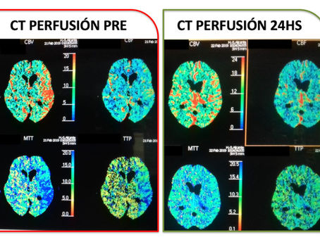 Our latest cases with Neuro Elutax "3"