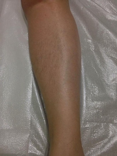 epilation.jpg