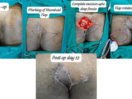 Rhomboid (Limberg) Flap Repair for Complex Pilonidal Sinus at Geetanjali Multispeciality Hospital, Wai