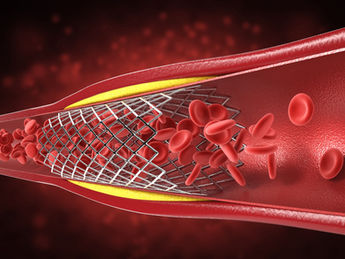 Coronary Angioplasty: Risks, Benefits, And Post-Op Care
