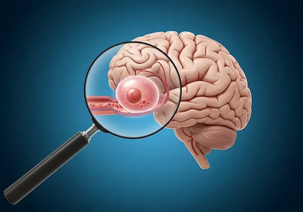 Brain Aneurysm: The Silent Threat and the "Worst Headache of Your Life