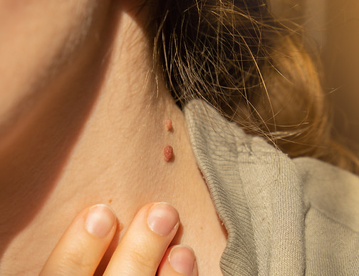 Top Skin Tag & Mole Removal | Safer Laser Removal