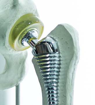 Prosthesis phot for site.jpg