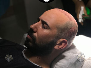 Quel saison choisir pour faire une greffe de cheveux ?