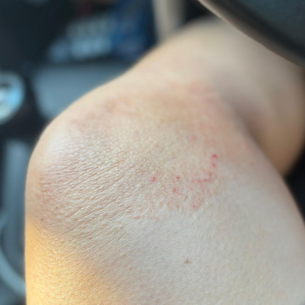 Die Ergebnisse der Totika Health-Kundin zeigen die betroffene Stelle eines Sommerausschlags nach weniger als einer Woche Anwendung des Totika Health Skincare Magic Serums.