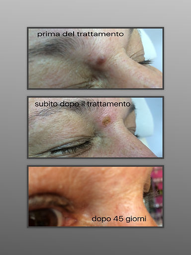 RIMOZIONE NEI - STUDIO MEDICO KIRONE - ROMA