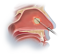 Biodesign Sinonasal Repair Graft